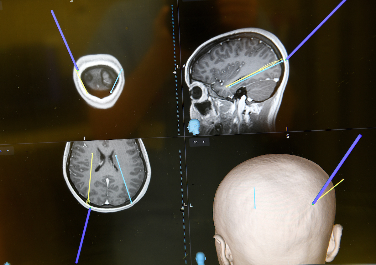 Diagram where Addison's brain surgery took place