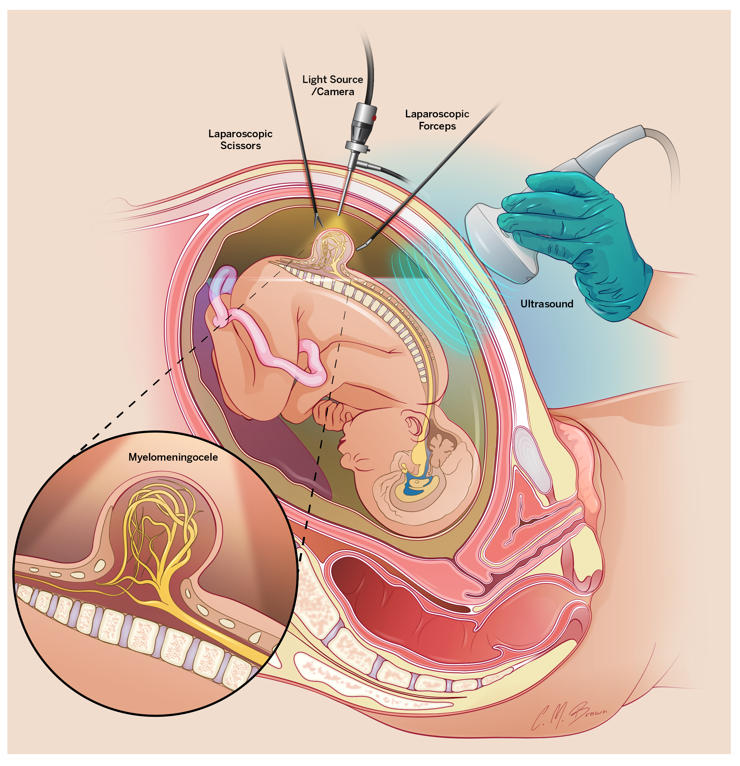 fetal myelomeningocele repair