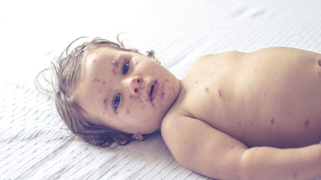 View more about As measles cases spread, doctors issue warning