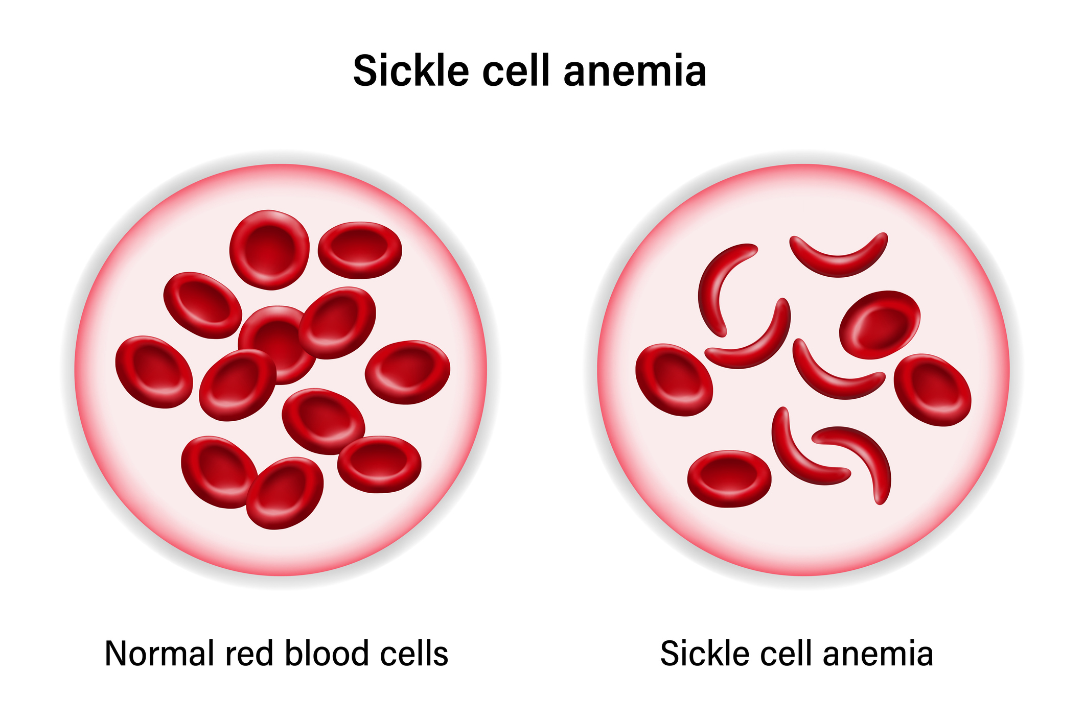 Sickle Cell