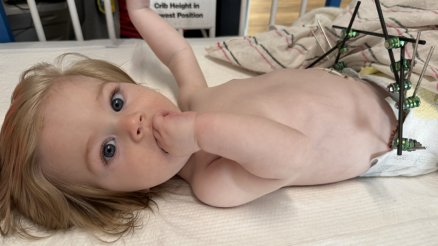 View more about Bladder exstrophy patient steals hearts of Riley staff